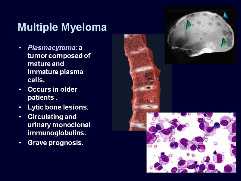 Multiple Myeloma Plasmacytoma: a tumor composed of mature and immature plasma cells. Occurs in